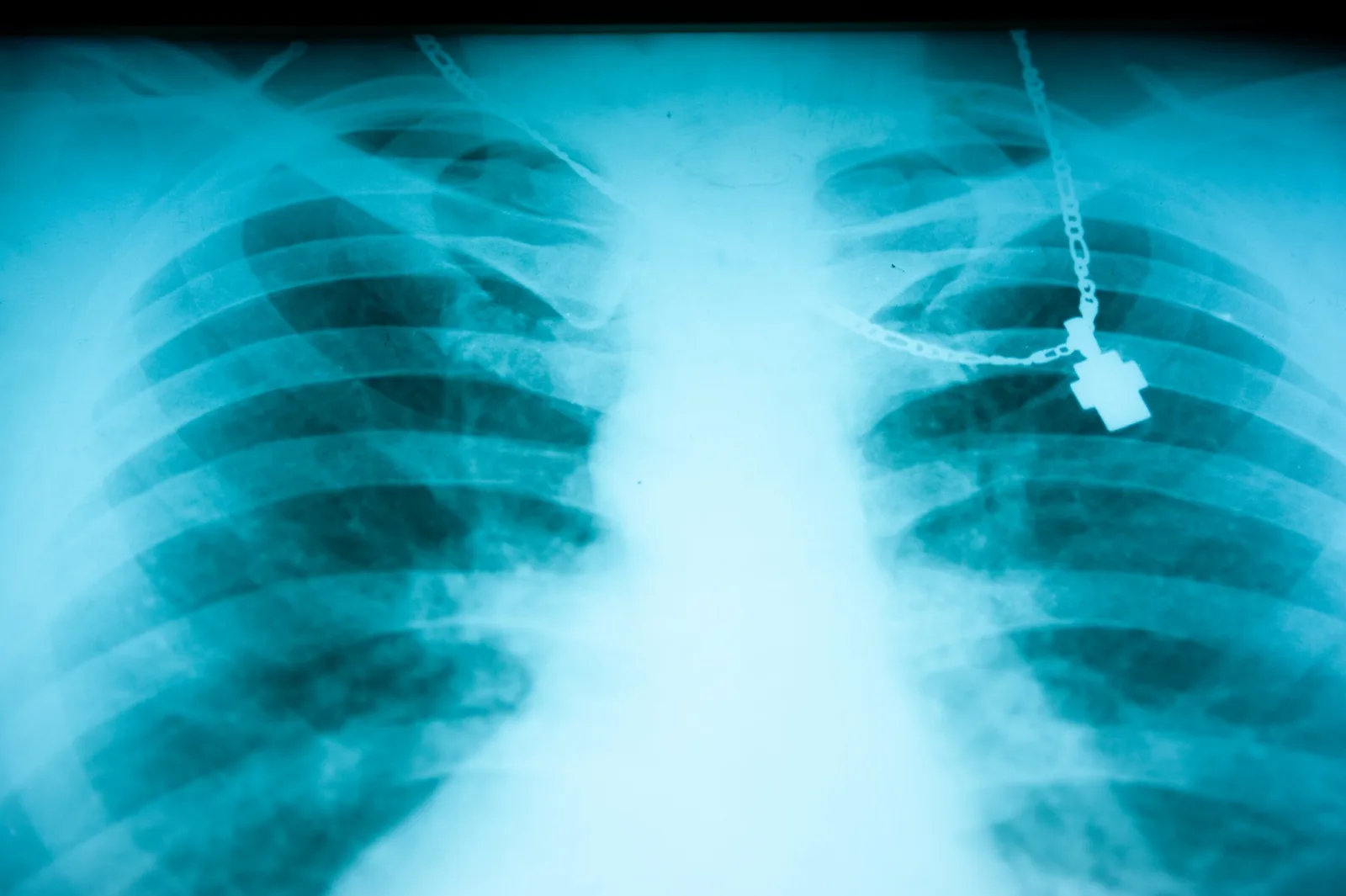Holy Smear still: a chest X-ray with a cross pendant on the light box